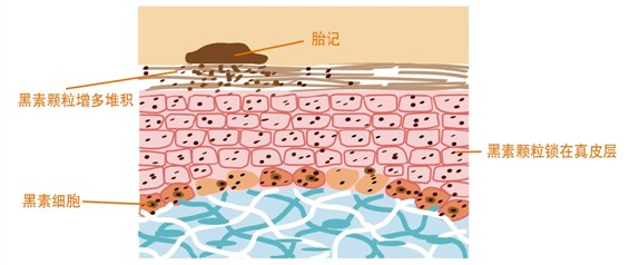 后背腰有胎记代表什么